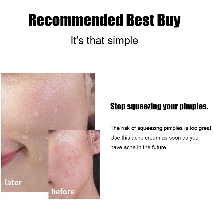 LOVILDS™ Salicylic Acid Acne Cream