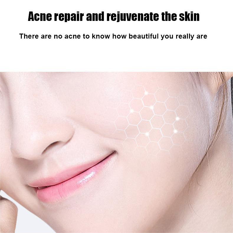 LOVILDS™ Salicylic Acid Acne Cream
