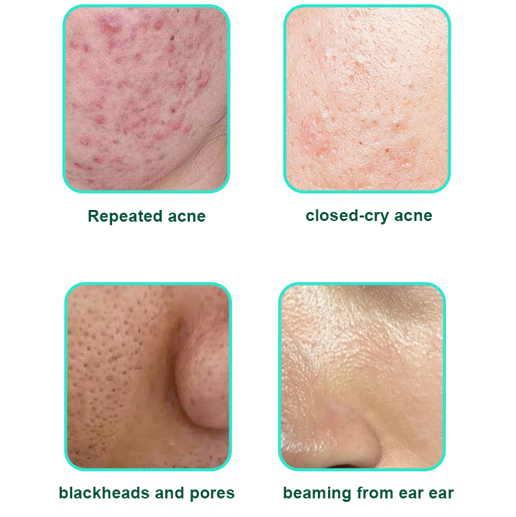 LOVILDS™ Salicylic Acid Acne Cream