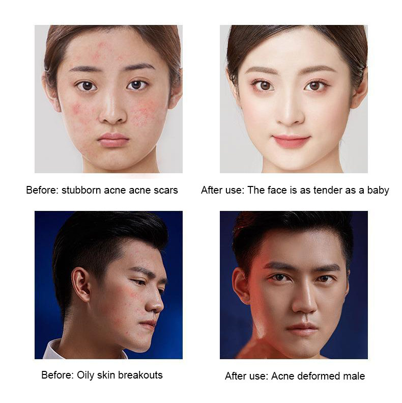 LOVILDS™ Salicylic Acid Acne Cream