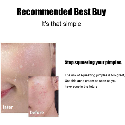 LOVILDS™ Salicylic Acid Acne Cream