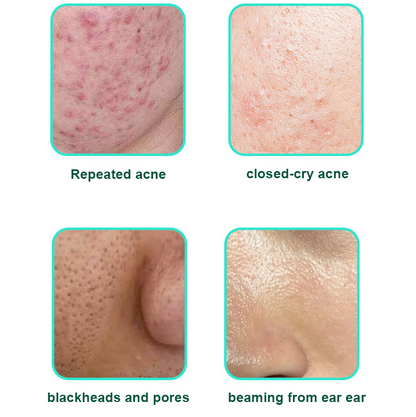 LOVILDS™ Salicylic Acid Acne Cream